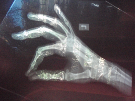 X ray of hand - doctor, hand, x ray, fingers, photography, bones