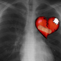 Chest x Ray