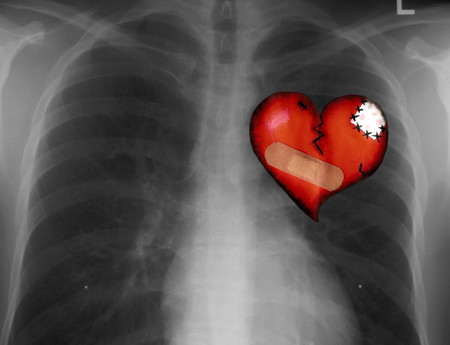 Chest x Ray - broken heart, chest, x ray, heart