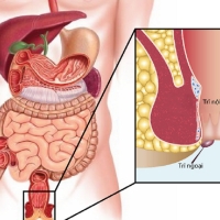 Bá»‡nh trÄ© và các phÆ°Æ¡ng pháp Ä‘iá»u trá»‹