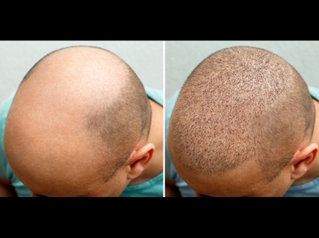 Hair Restoration - best Scalp Micropigmintation, Hair treatment, Hair restoration, PRP therapy