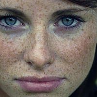 Freckles