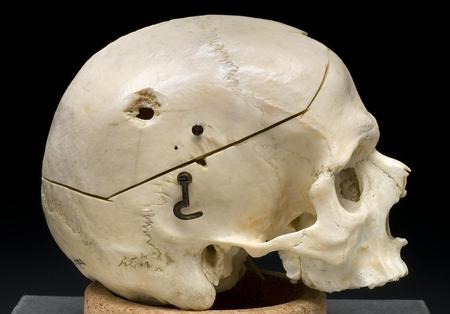 Small Calibre Gunshot Trauma - skull, abstract, damage, photography, trauma